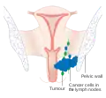 Stage 3 vaginal cancer