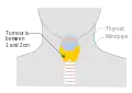 Stage T1b thyroid cancer