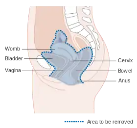 Diagram showing the area removed with a total operation