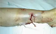 Gustilo type I open fracture